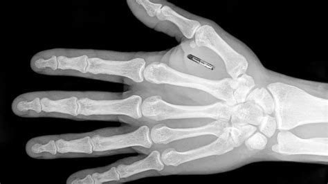 first rfid chip|chip implanted in the hand.